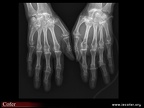 hémochromatose génétique: radiographie des mains